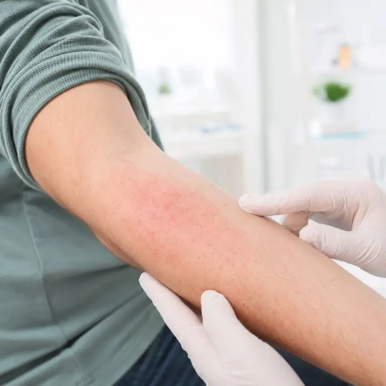 Dermatitis