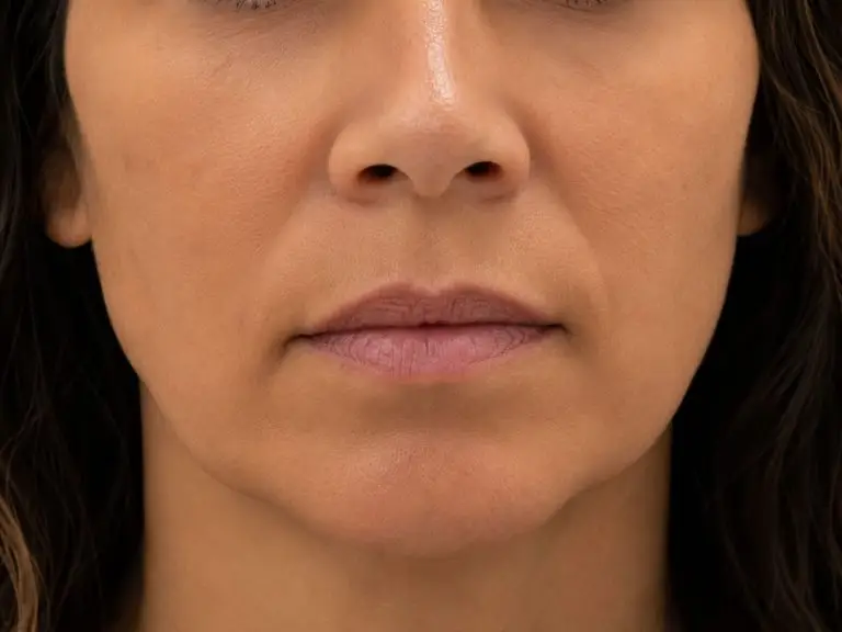 Fillers