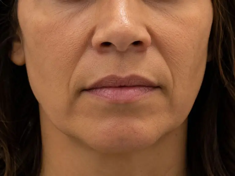 Fillers