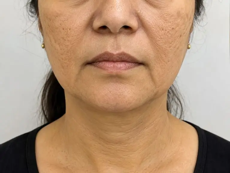 MicroPen EVO (Micro-Needling)