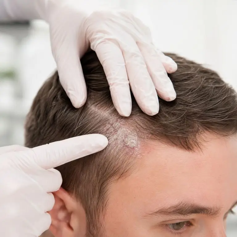 Psoriasis