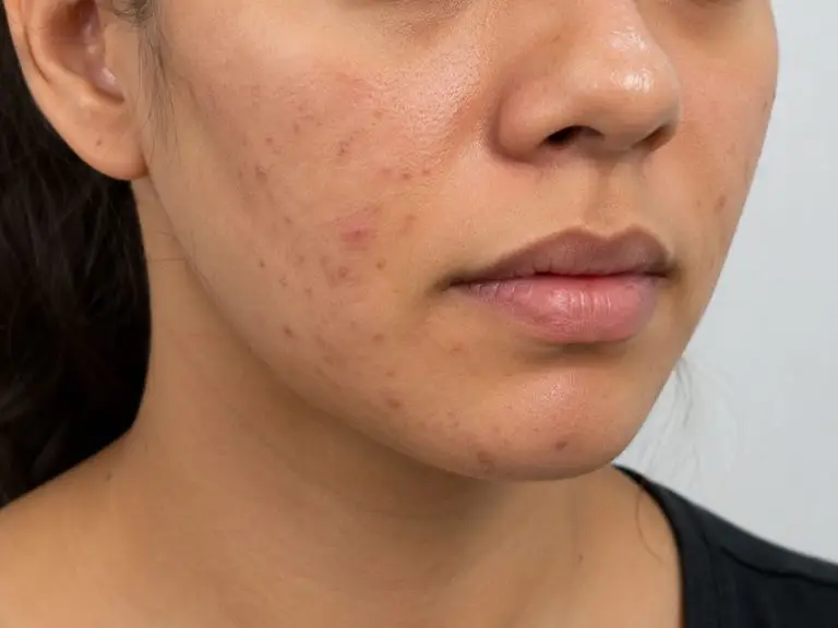 VI Peel Precision Plus & Purify (Chemical Peels)