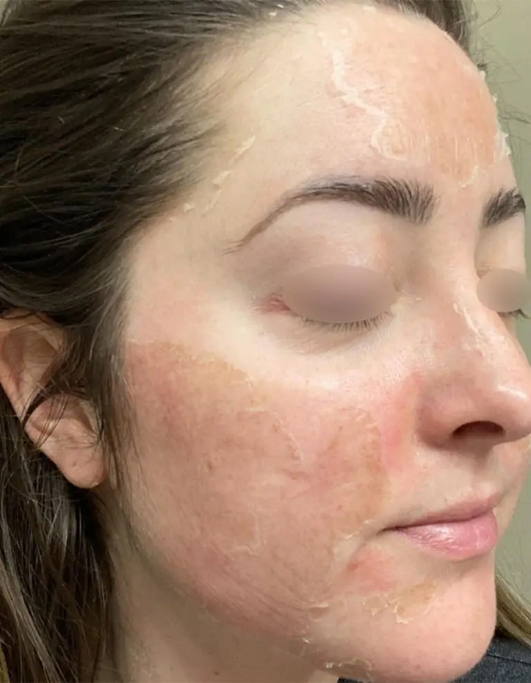 VI Peel Precision Plus & Purify (Chemical Peels)