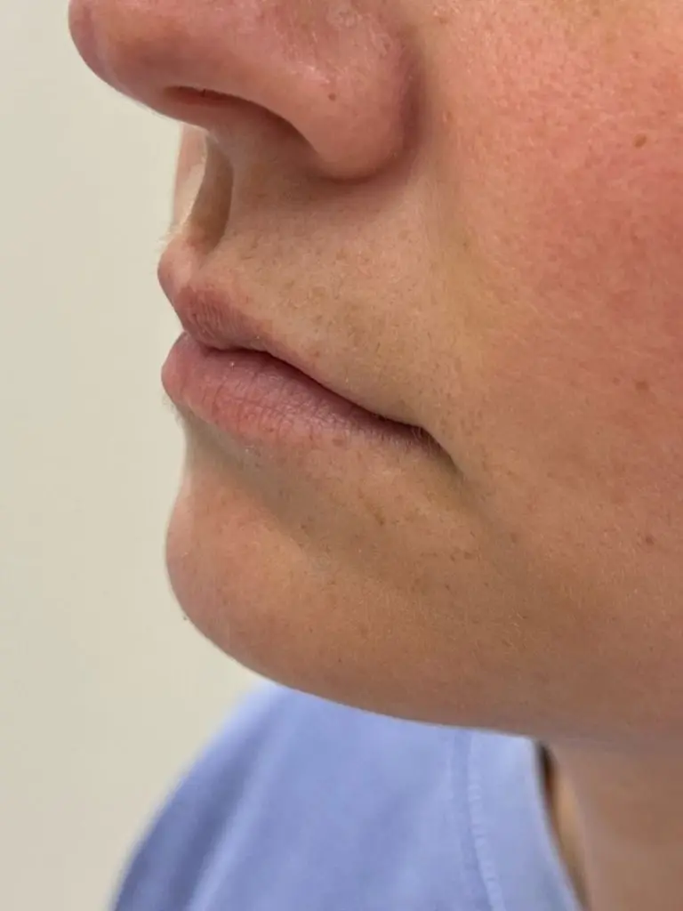Lip Filler