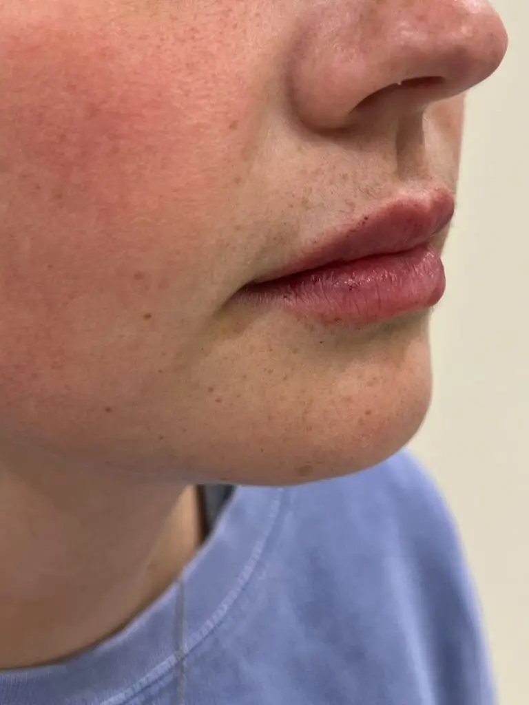 Lip Filler