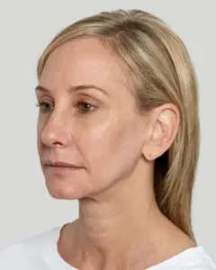 Sculptra Heidi After