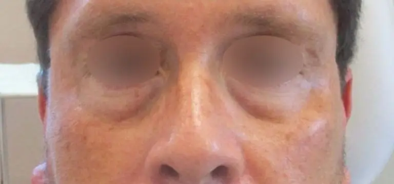 Undereye Filler